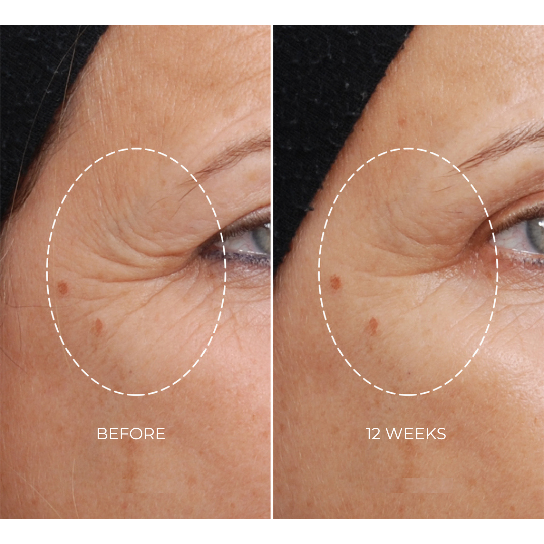 NEWA Plus - Cordless RF Wrinkle Reduction Device