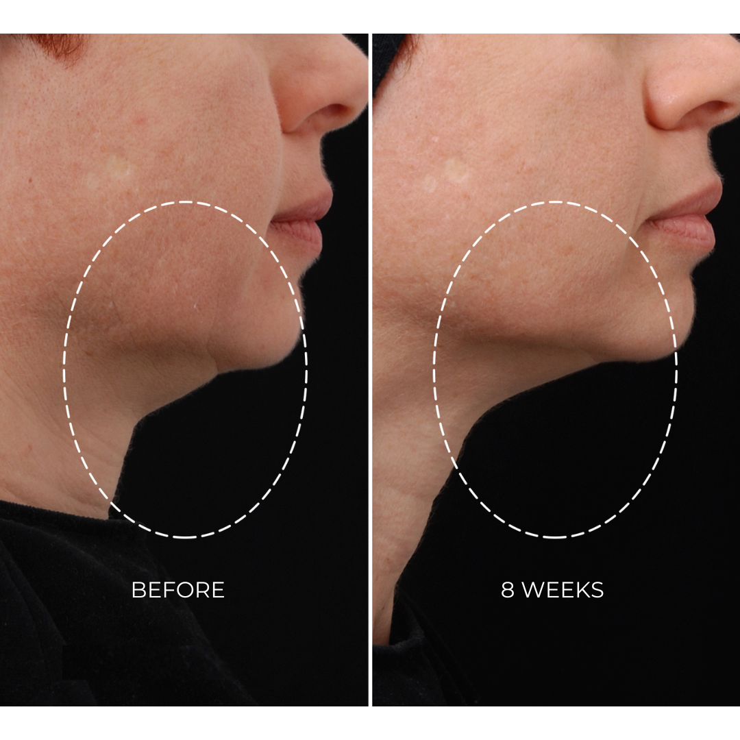 NEWA Plus - Cordless RF Wrinkle Reduction Device