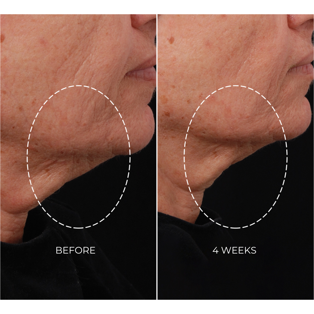 NEWA Plus - Cordless RF Wrinkle Reduction Device