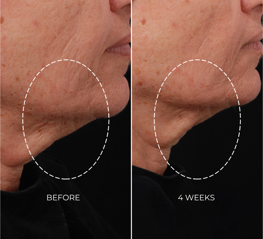 NEWA: Clinically Proven Skin Tightening with RF Technology NEWA: Clinically Proven Skin Tightening with RF Technology