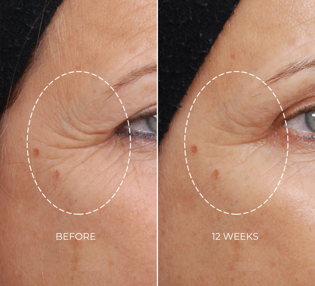 NEWA: Clinically Proven Skin Tightening with RF Technology NEWA: Clinically Proven Skin Tightening with RF Technology