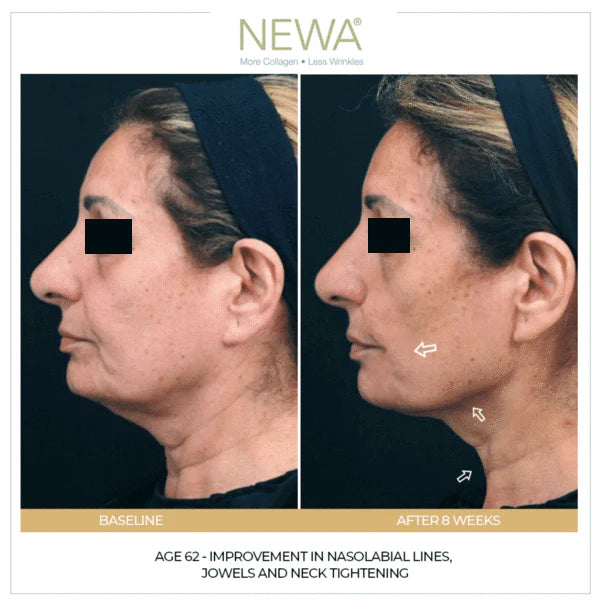 RF Skin Tightening Before and After | NEWA