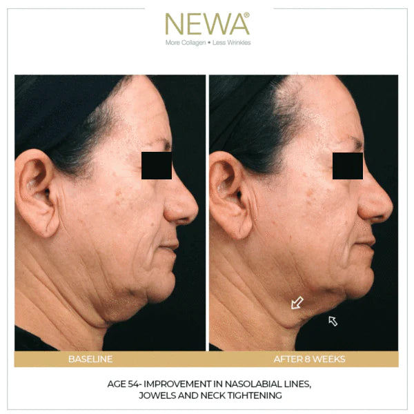 RF Skin Tightening Before and After | NEWA
